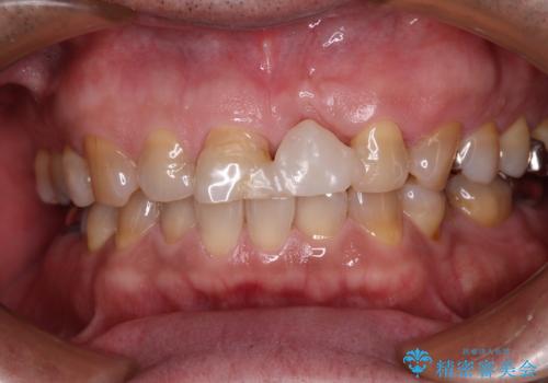 歯茎に溝が 大きく欠損した前歯のインプラント補綴治療の治療中