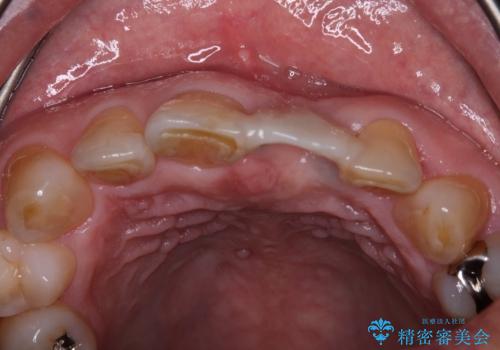 歯茎に溝が　大きく欠損した前歯のインプラント補綴治療の治療前