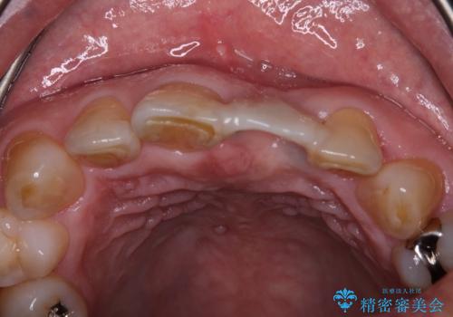 歯茎に溝が 大きく欠損した前歯のインプラント補綴治療の治療前