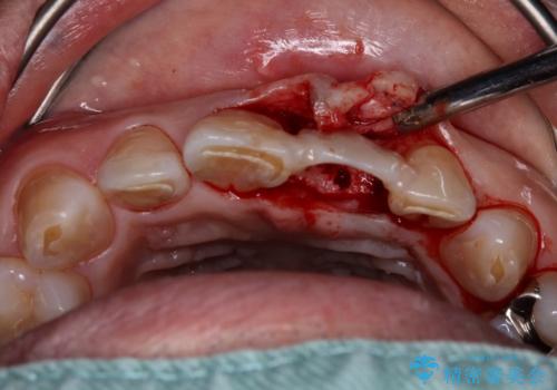 歯茎に溝が　大きく欠損した前歯のインプラント補綴治療の治療中