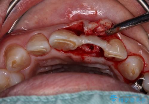 歯茎に溝が 大きく欠損した前歯のインプラント補綴治療の治療中