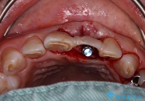 歯茎に溝が　大きく欠損した前歯のインプラント補綴治療の治療前