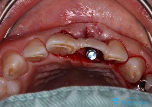 歯茎に溝が 大きく欠損した前歯のインプラント補綴治療の治療前