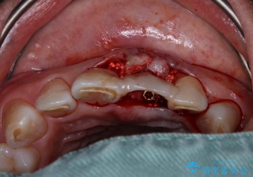 歯茎に溝が　大きく欠損した前歯のインプラント補綴治療の治療後