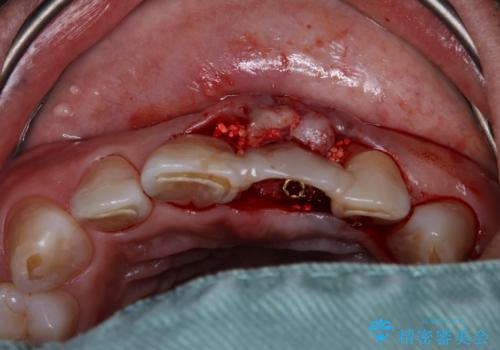 歯茎に溝が 大きく欠損した前歯のインプラント補綴治療の治療後