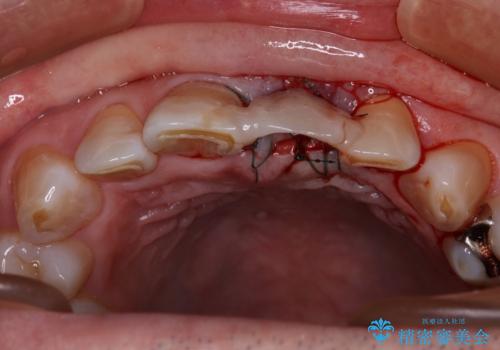 歯茎に溝が　大きく欠損した前歯のインプラント補綴治療の治療中
