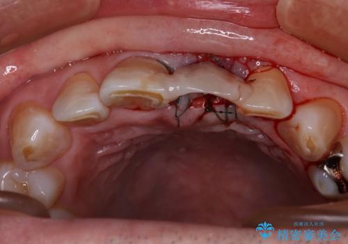 歯茎に溝が 大きく欠損した前歯のインプラント補綴治療の治療中
