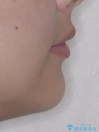 口元が出ているのを改善したい。 クリアブラケットによる抜歯矯正の治療後(顔貌)