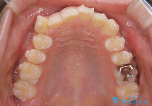 インビザラインで八重歯の治療の治療中