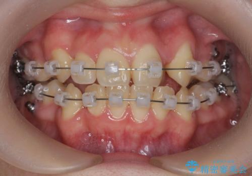 歯並びのせいで歯ブラシがしづらい　マルチブラケットを用いた抜歯矯正の治療中