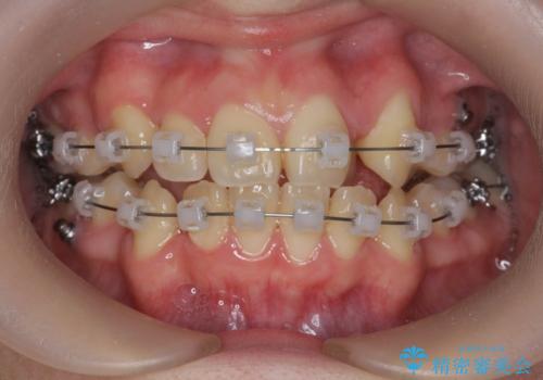 歯並びのせいで歯ブラシがしづらい マルチブラケットを用いた抜歯矯正の治療中