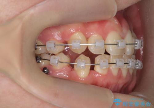 歯並びのせいで歯ブラシがしづらい マルチブラケットを用いた抜歯矯正の治療中
