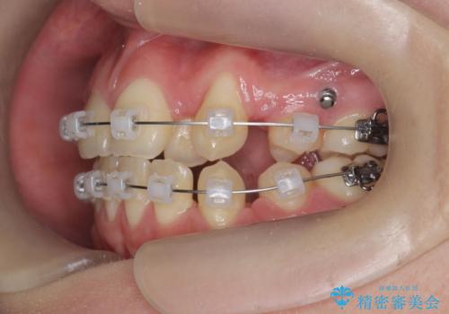 歯並びのせいで歯ブラシがしづらい マルチブラケットを用いた抜歯矯正の治療中