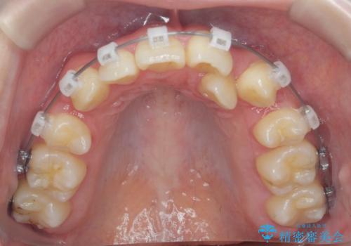 歯並びのせいで歯ブラシがしづらい　マルチブラケットを用いた抜歯矯正の治療中