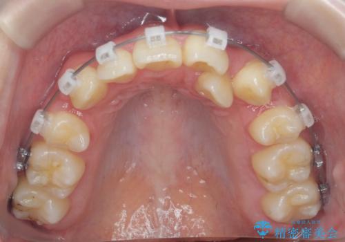 歯並びのせいで歯ブラシがしづらい マルチブラケットを用いた抜歯矯正の治療中
