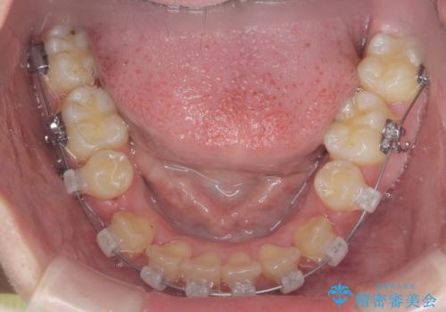 歯並びのせいで歯ブラシがしづらい　マルチブラケットを用いた抜歯矯正の治療中