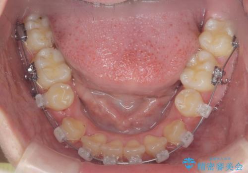 歯並びのせいで歯ブラシがしづらい マルチブラケットを用いた抜歯矯正の治療中