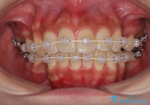 気になる上顎前突 補助装置を用いた抜歯矯正で口元をすっきりとの治療中