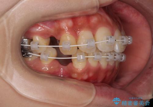 気になる上顎前突 補助装置を用いた抜歯矯正で口元をすっきりとの治療中