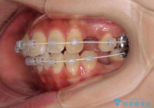 気になる上顎前突 補助装置を用いた抜歯矯正で口元をすっきりとの治療中