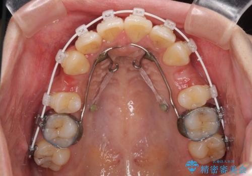 気になる上顎前突 補助装置を用いた抜歯矯正で口元をすっきりとの治療中