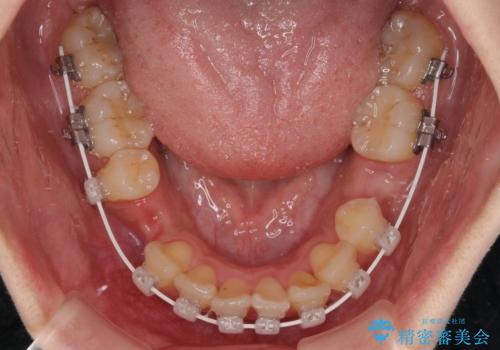 気になる上顎前突 補助装置を用いた抜歯矯正で口元をすっきりとの治療中