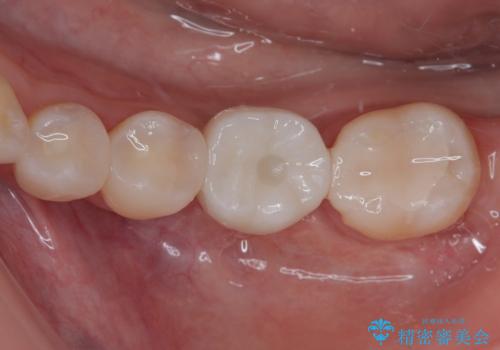 奥歯にインプラントを入れて銀歯もやり替えたい。