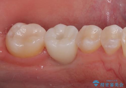 奥歯にインプラントを入れて銀歯もやり替えたい。の治療後