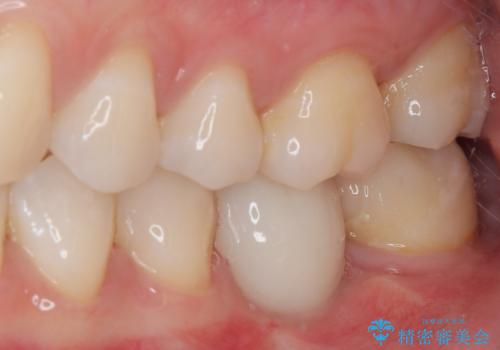奥歯にインプラントを入れて銀歯もやり替えたい。の治療後