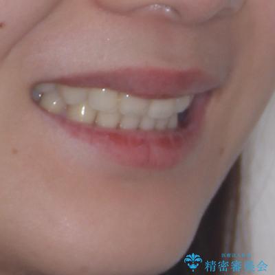 前歯のデコボコを抜歯矯正でスッキリした口元にの治療後(顔貌)