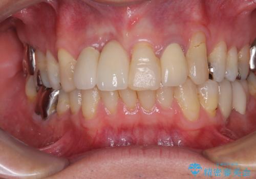 痛む前歯　破折してしまった歯のインプラント補綴治療の治療後