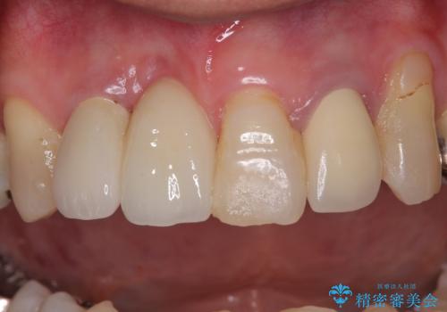 痛む前歯　破折してしまった歯のインプラント補綴治療の治療後