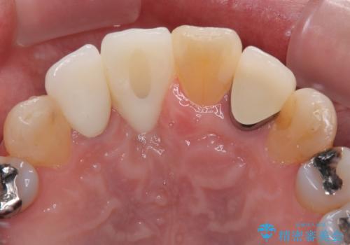 痛む前歯　破折してしまった歯のインプラント補綴治療の治療後