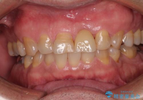 歯茎に溝が 大きく欠損した前歯のインプラント補綴治療の治療後