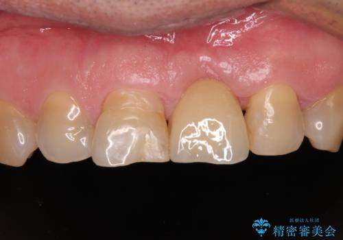 歯茎に溝が 大きく欠損した前歯のインプラント補綴治療の症例 治療後