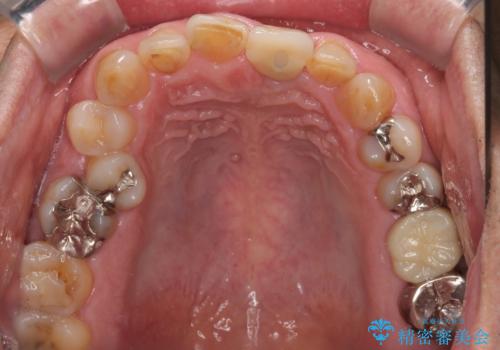歯茎に溝が 大きく欠損した前歯のインプラント補綴治療の治療後