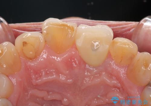 歯茎に溝が　大きく欠損した前歯のインプラント補綴治療の治療後