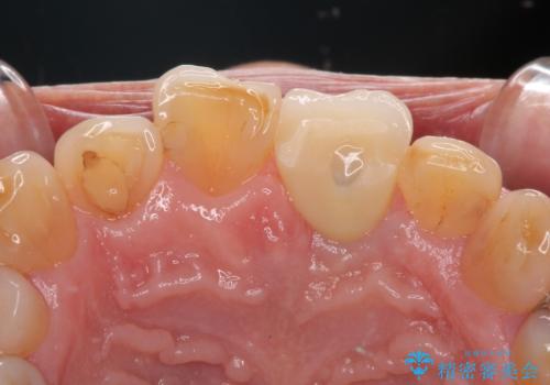 歯茎に溝が 大きく欠損した前歯のインプラント補綴治療の治療後