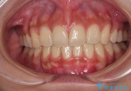 気になる上顎前突 補助装置を用いた抜歯矯正で口元をすっきりとの症例 治療後