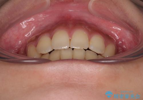 気になる上顎前突 補助装置を用いた抜歯矯正で口元をすっきりとの治療後