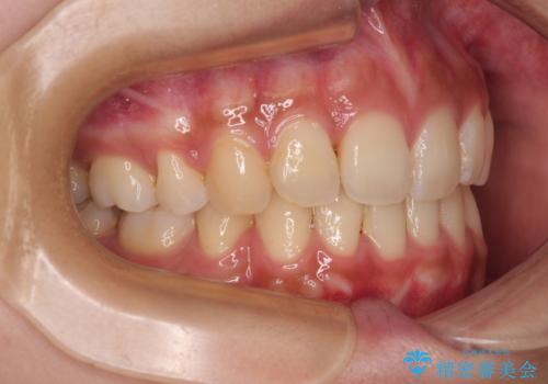 気になる上顎前突 補助装置を用いた抜歯矯正で口元をすっきりとの治療後