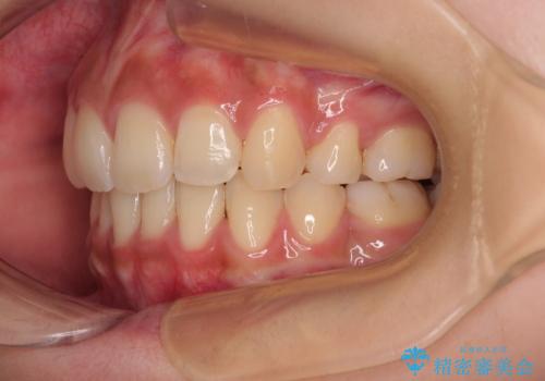 気になる上顎前突 補助装置を用いた抜歯矯正で口元をすっきりとの治療後