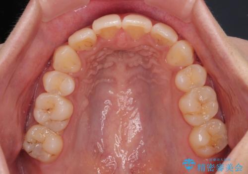 気になる上顎前突 補助装置を用いた抜歯矯正で口元をすっきりとの治療後