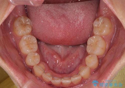 気になる上顎前突 補助装置を用いた抜歯矯正で口元をすっきりとの治療後