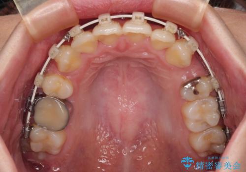 前歯のデコボコを抜歯矯正でスッキリした口元にの治療中