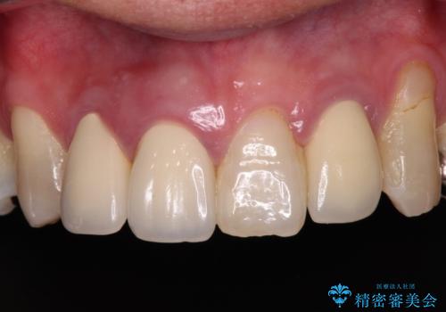 痛む前歯 破折してしまった歯のインプラント補綴治療の症例 治療前