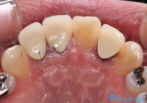痛む前歯　破折してしまった歯のインプラント補綴治療の治療前