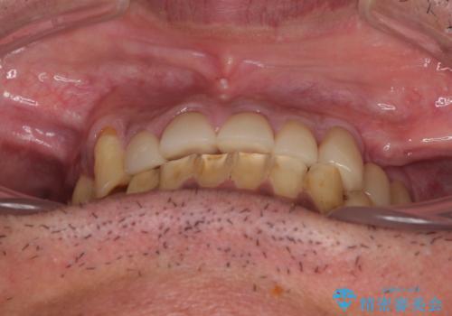 反対咬合ですり減った前歯とむし歯だらけの奥歯 総合歯科治療の治療後