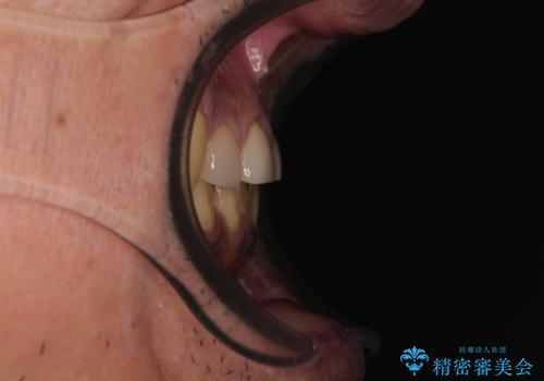 反対咬合ですり減った前歯とむし歯だらけの奥歯 総合歯科治療の治療後