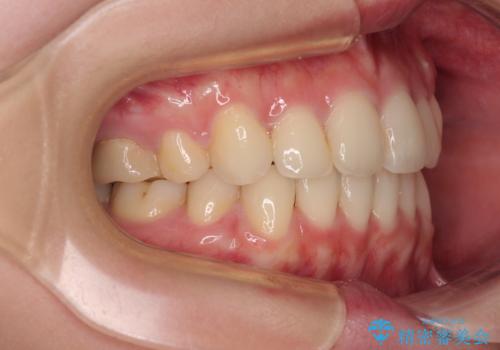 前歯のデコボコを抜歯矯正でスッキリした口元にの治療後